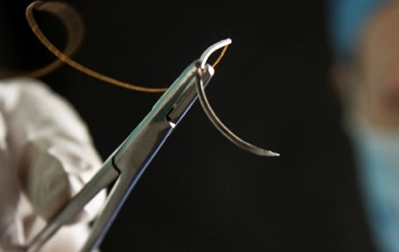 Highlighting Characteristics of Reverse Cutting Suture Needle