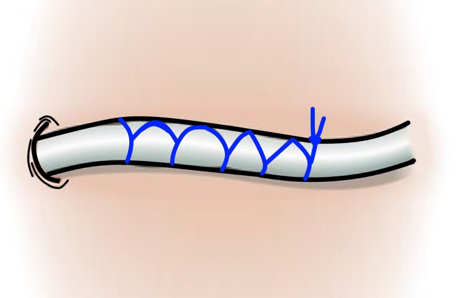 Continuous Sutures