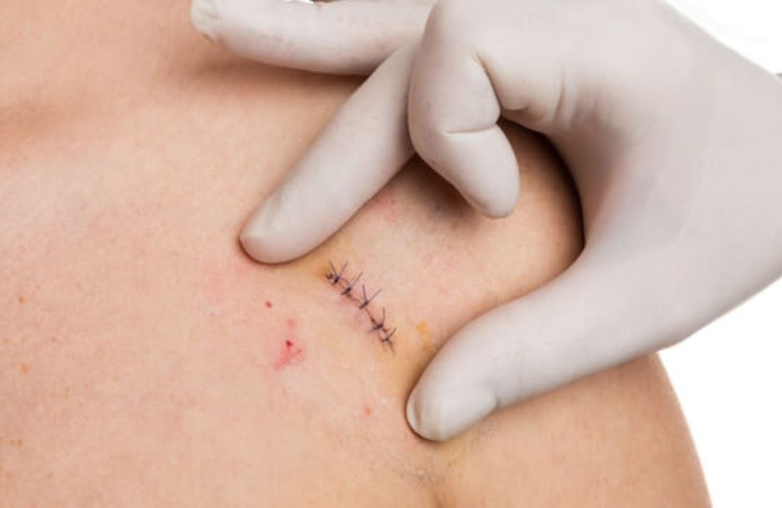 C-Section Closure
