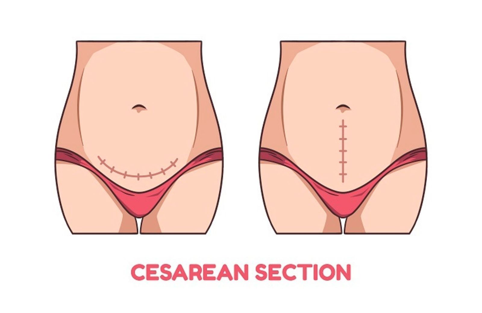 Caesarean section incision direction