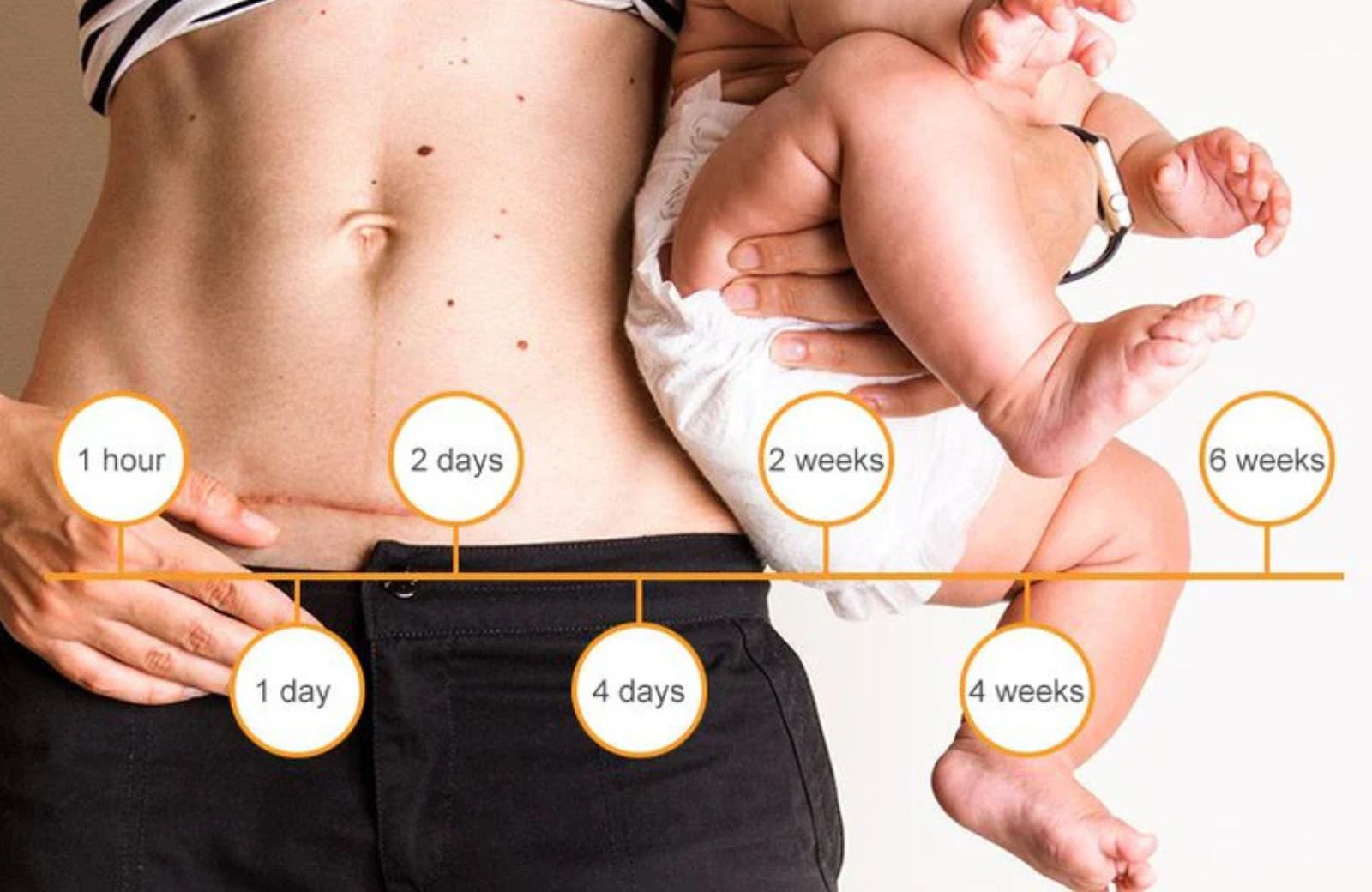 Caesarean section recovery