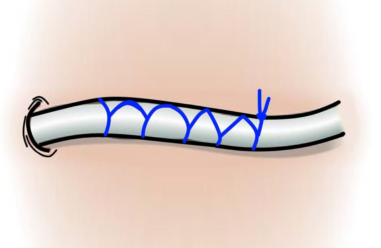 Blue Stitches Dissolvable