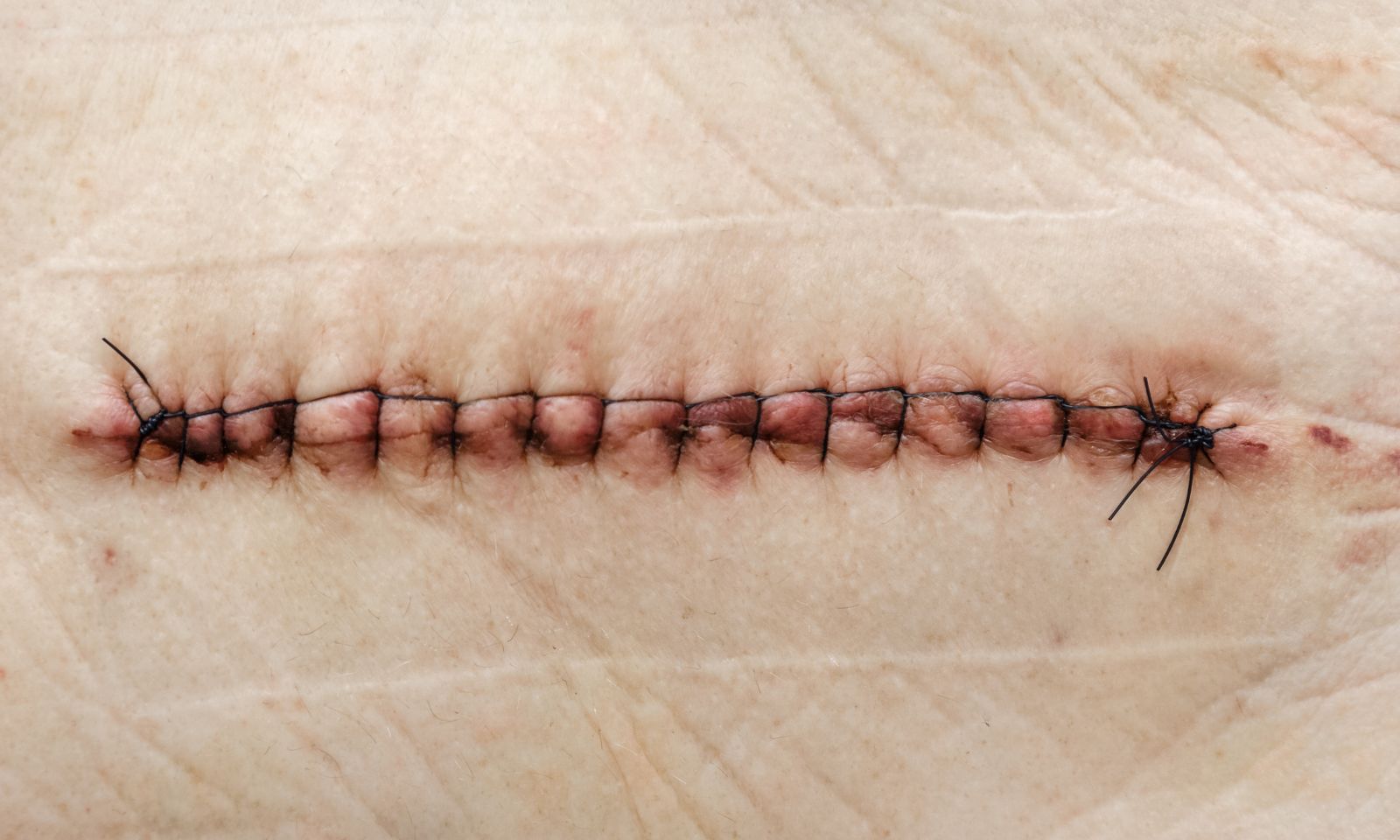 Polyglycolic Acid Suture Vicryl in Wound Closure