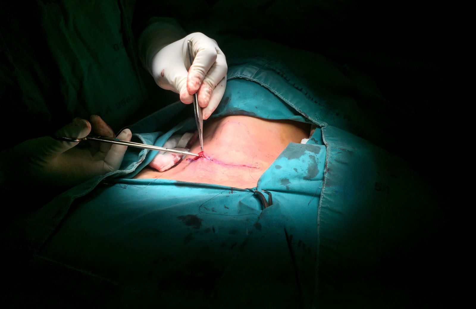 Wound Closure Application