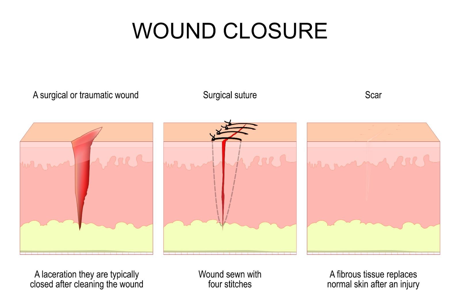 How Blanket Sutures Enhance Wound Healing