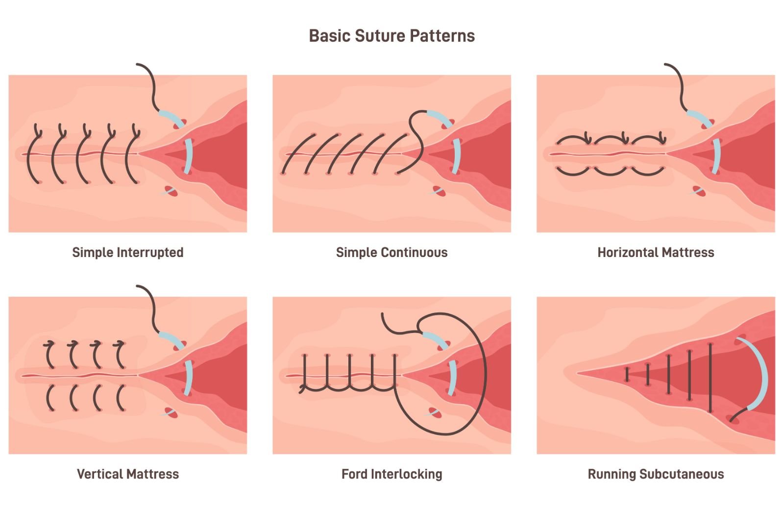Basic Suture Patterns