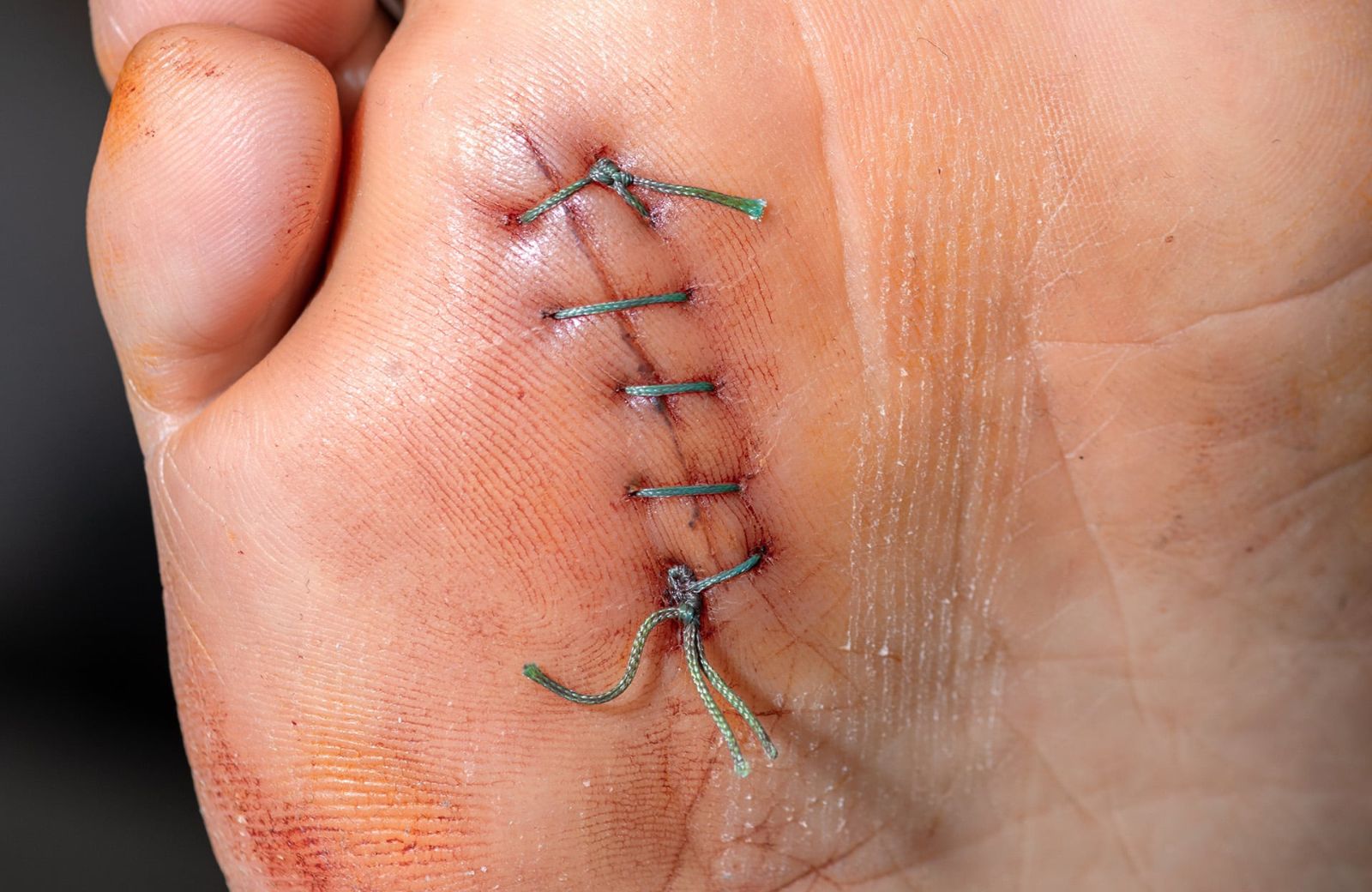 Foot Stitching