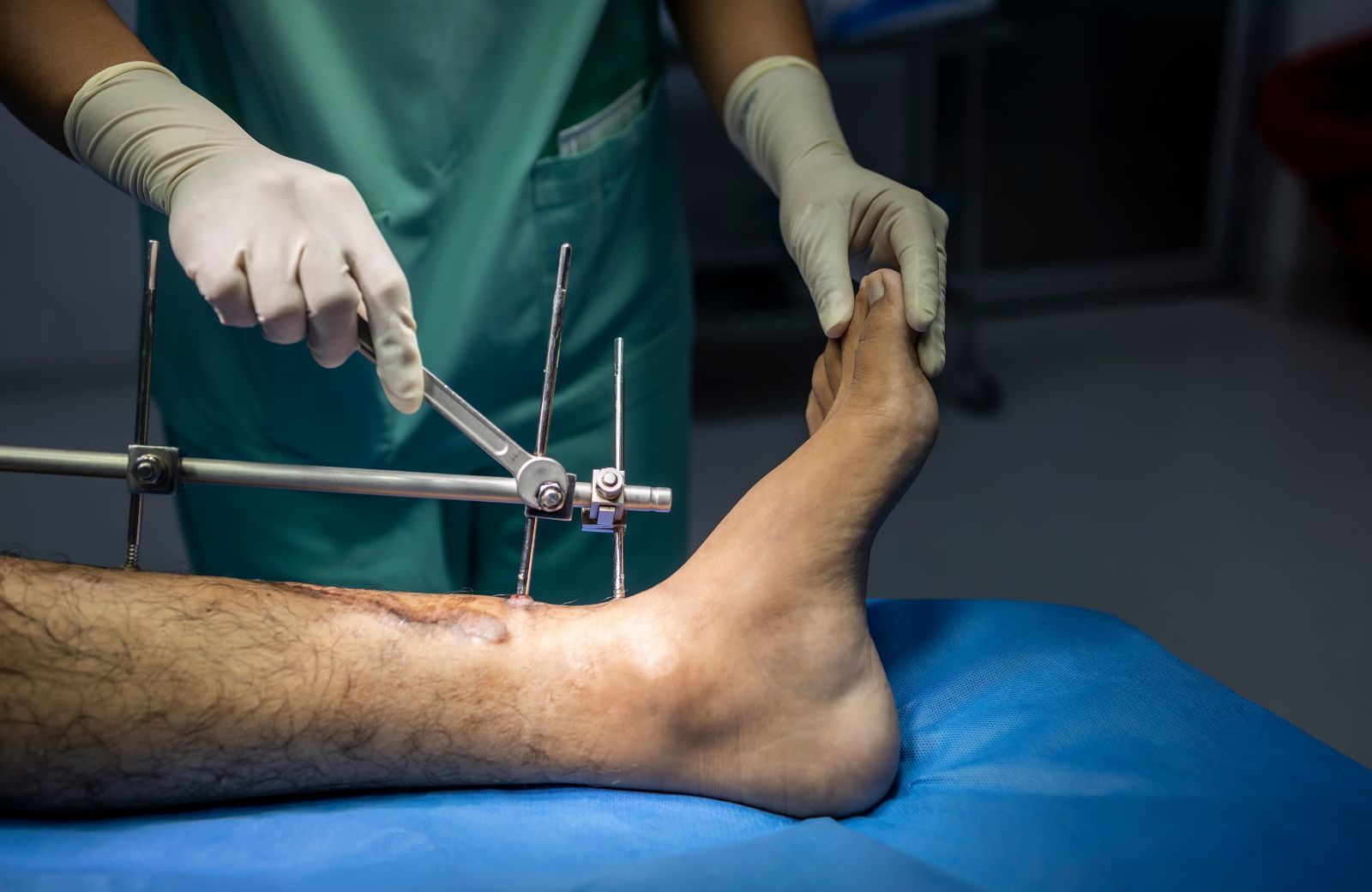 Orthopedic Surgery Suture