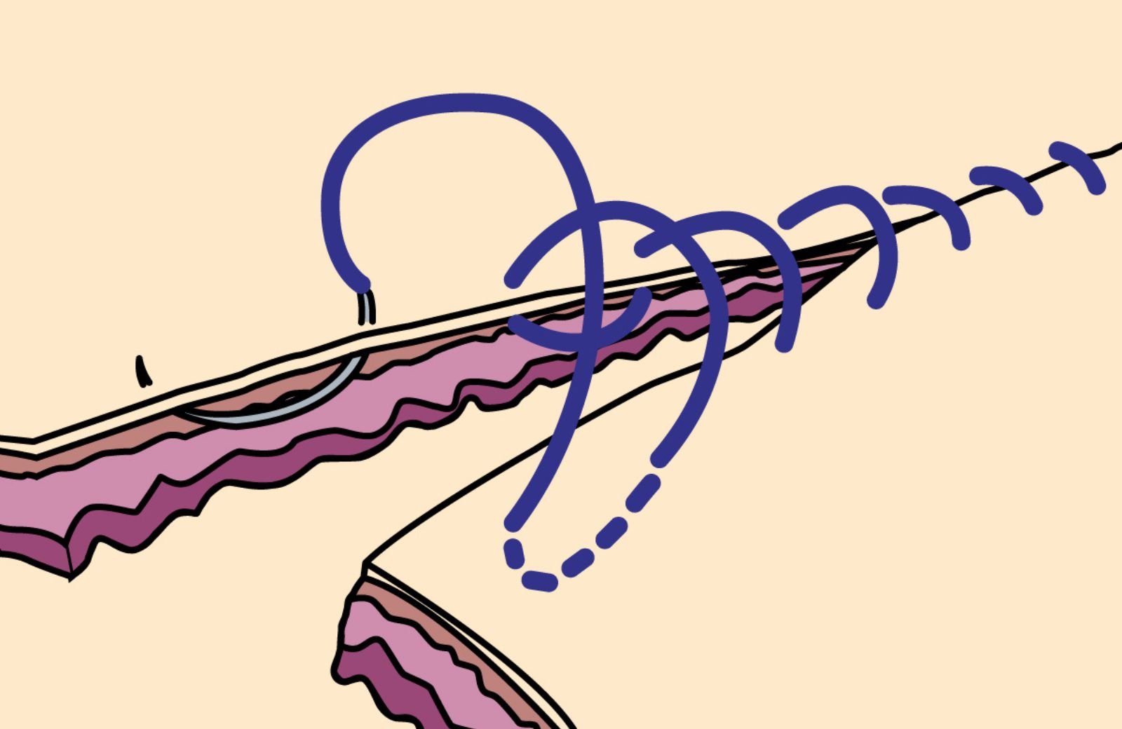 Suture Pattern