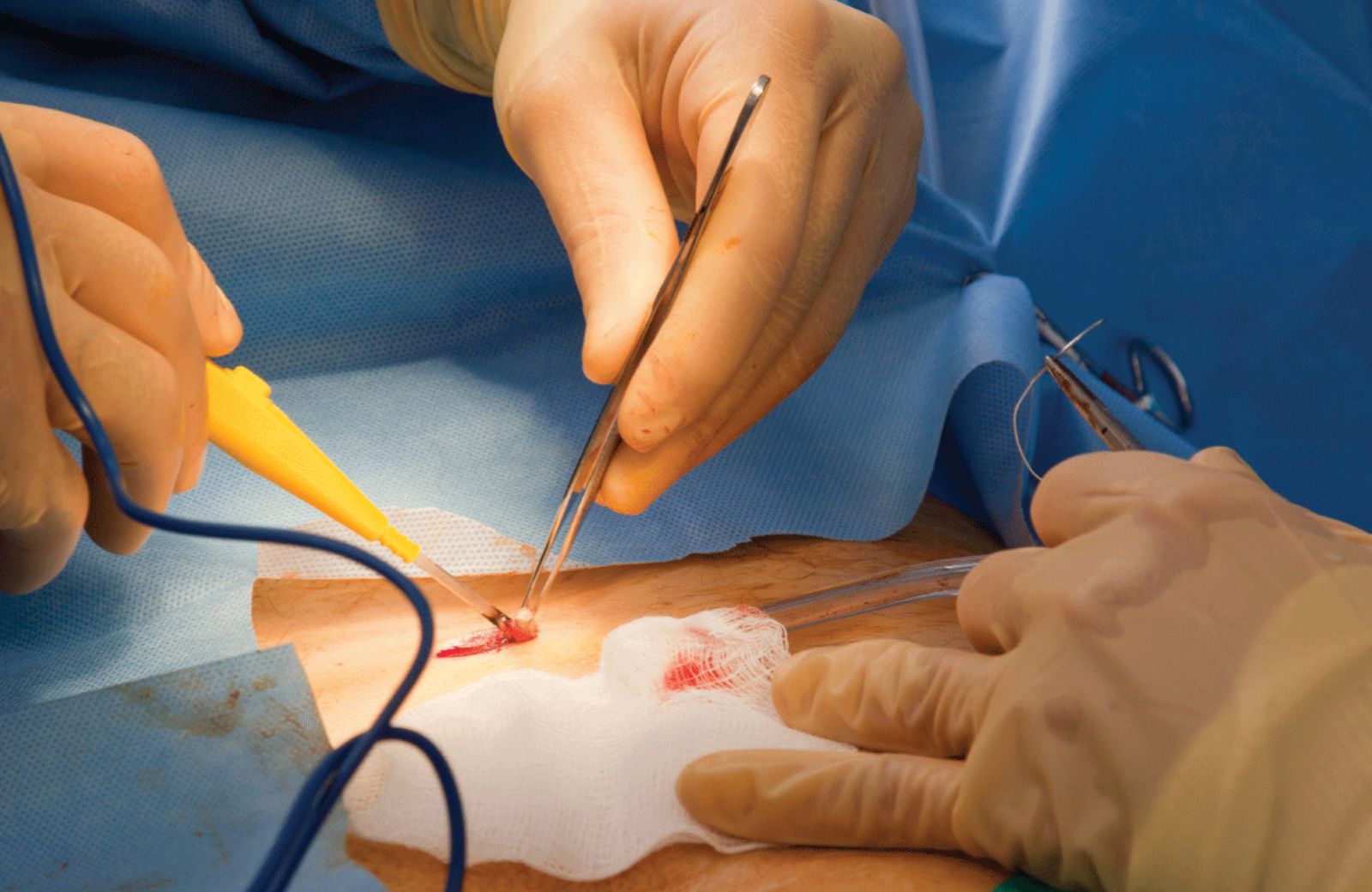 Suture Removal Procedure