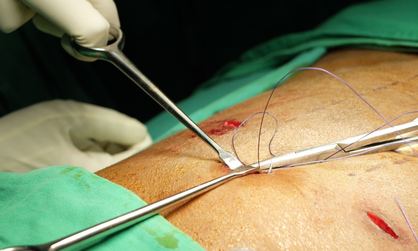 Understanding Sutures A Comprehensive Definition in Medical Practice