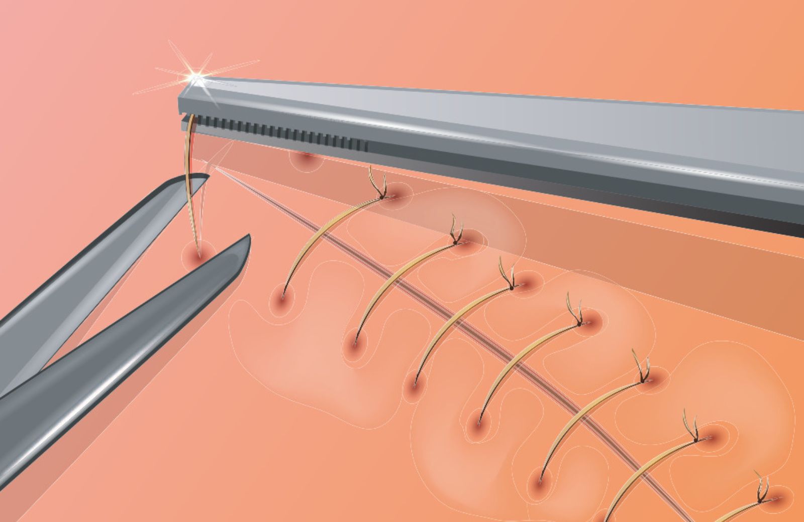 Understanding the Suture Definition in Medical Context